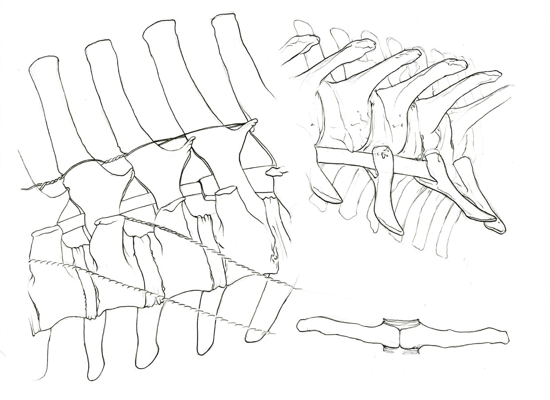 Line drawings of sections of a spine.